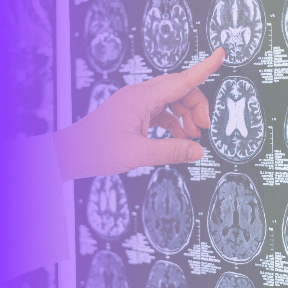 Alzheimer's disease research